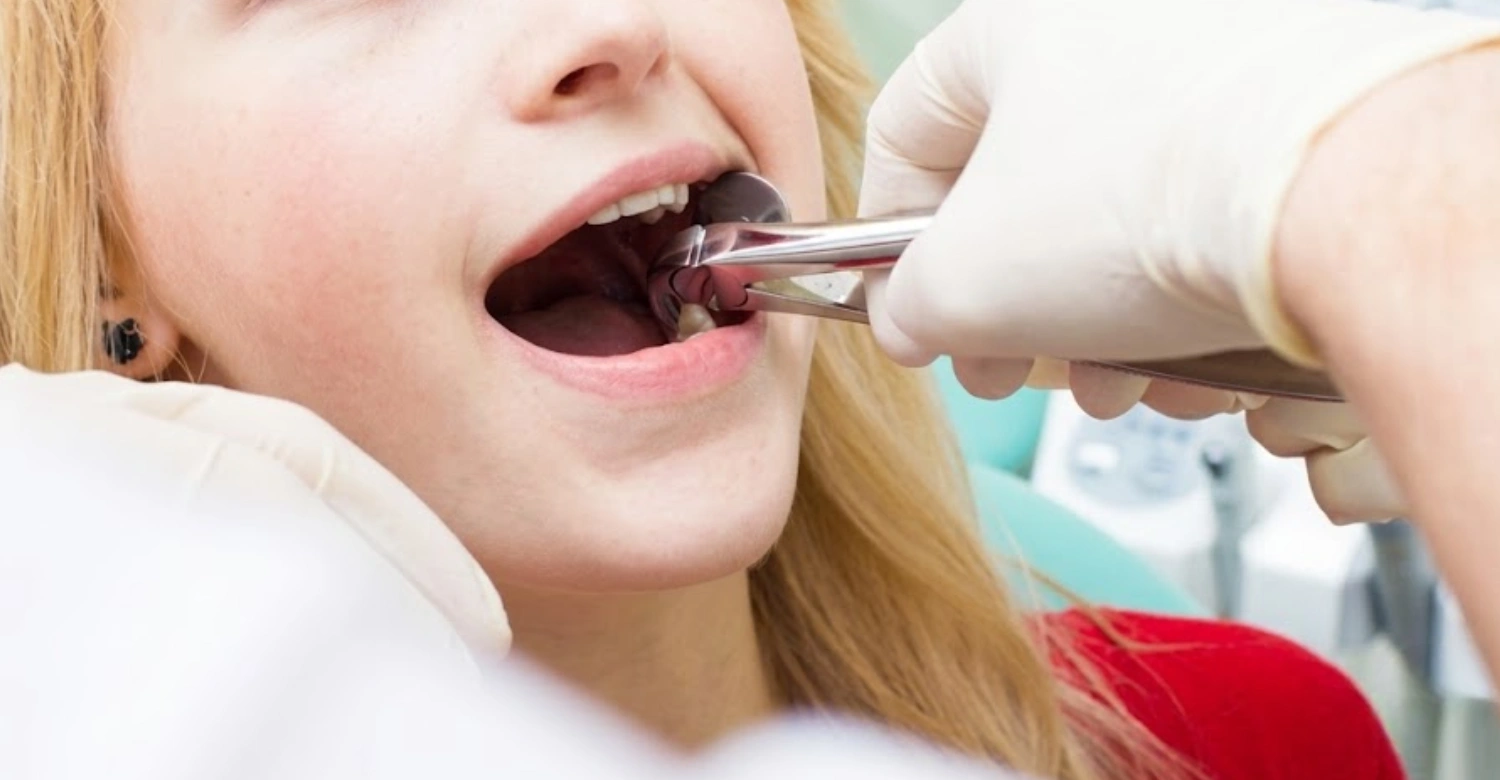 What to Eat After Wisdom Teeth Removal In blog